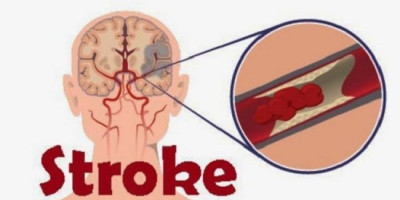 Siloam Hospitals Ambon Jelaskan Mitos dan Fakta Penyakit Stroke