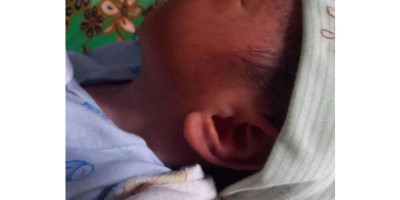 Heboh Kuping Bayi di Tangerang Mirip Lafadz Allah