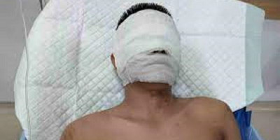 Diduga Beritakan Tentang Judi, Wartawan di Sumut Disiram OTK dengan Air Keras 