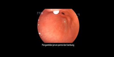 Dokter Berhasil Keluarkan Jarum Pentul dari Lambung Pasien, Viral di Media Sosial